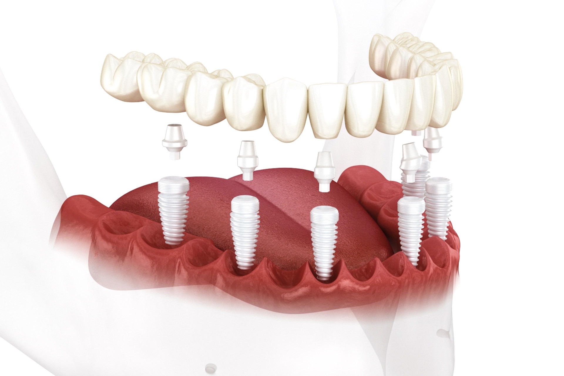 Zirconia Implants 1