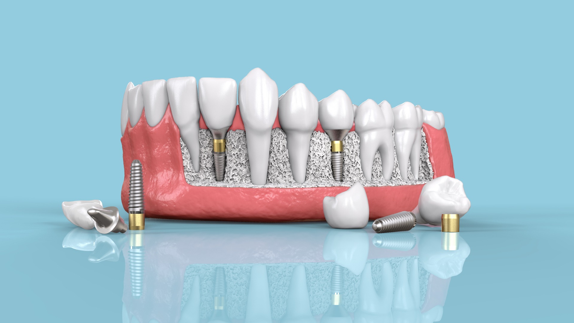 Everything You Need to Know About Zirconia Crowns and Dental Implants